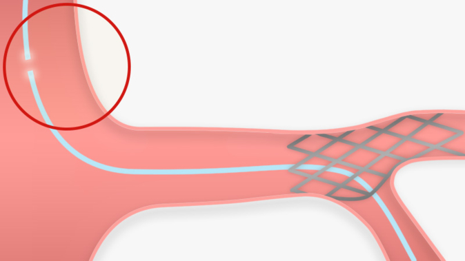 Protruding in aorta