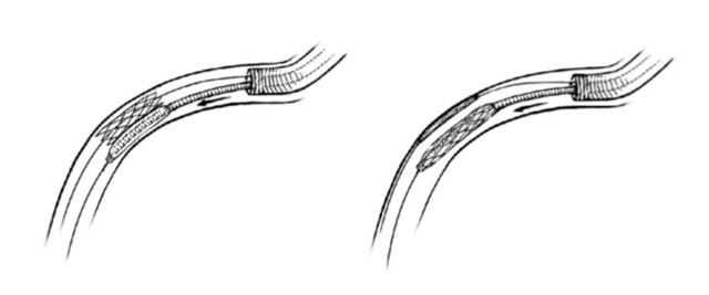 Stent crush technique