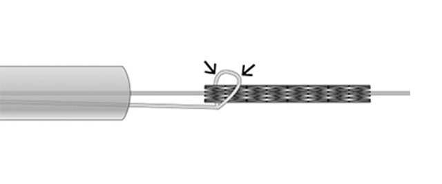Snare technique: devices used for foreign body retrieval