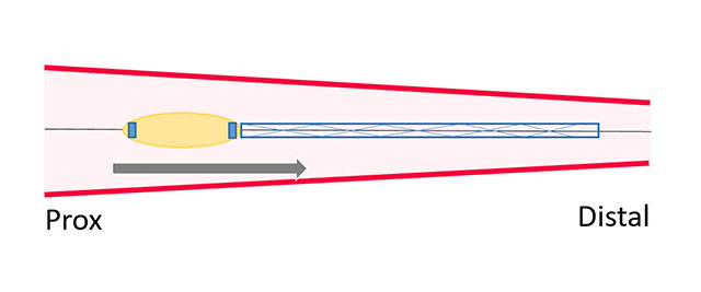 Stent advancement and deployment