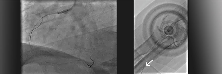 Stent lost and retrieved