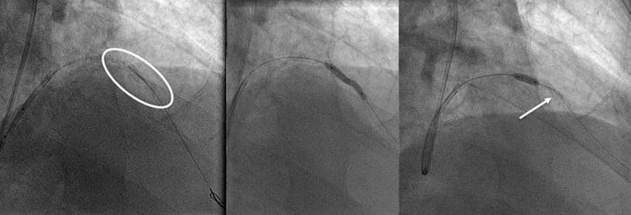 Is it really loose: solving stent