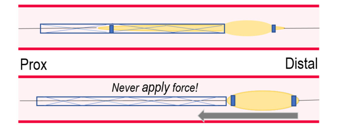Partial stent loss