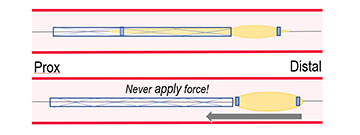 Partial stent loss: illustration