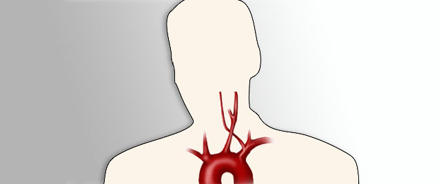 Stent loss in aorta or peripheral circulation