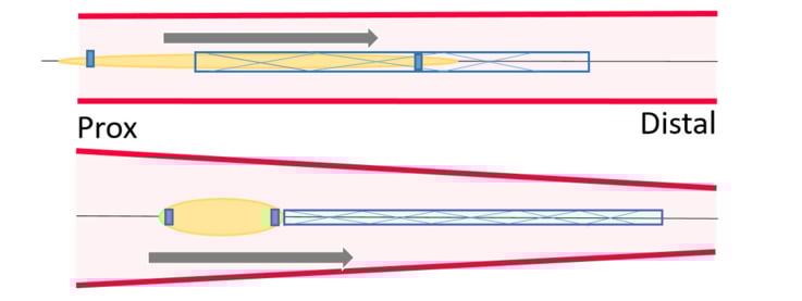 Total stent loss: guidewire in-situ