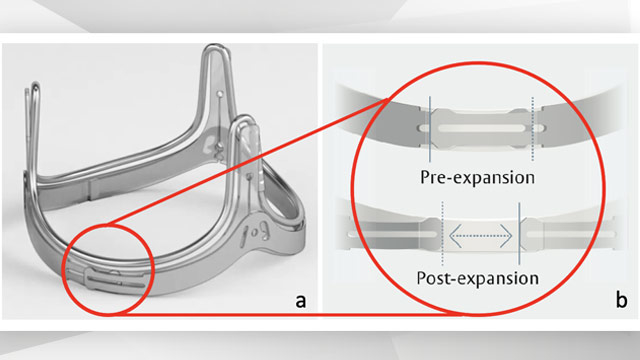 Controlled ring expansion during aortic valve-in-valve: a proof-of-concept CT-scan analysis