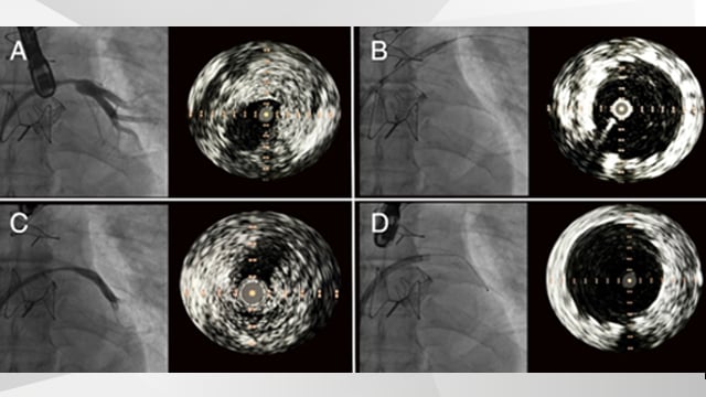 Quadruple pulmonary vein stenting for post-ablation stenosis