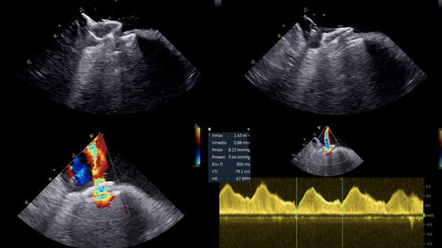 Interatrial shunt after mitral transcatheter edge-to-edge repair