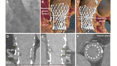 Rapid CT-guided emergency TAVI-in-TAVI-in-valve for cardiogenic shock with high coronary obstruction risk