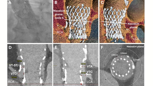 Rapid CT-guided emergency TAVI-in-TAVI-in-valve for cardiogenic shock with high coronary obstruction risk