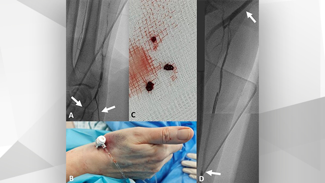 Distal radial approach to reaccess and recanalize the occluded radial artery