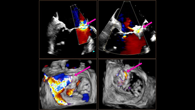 Interventional closure of LVOT to LA shunt after aortic valve replacement