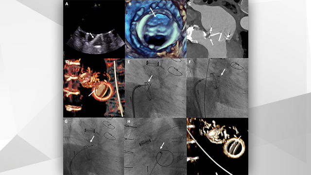 Successful rotablation of a calcium spike blocking the motion of a mechanical prosthetic leaflet