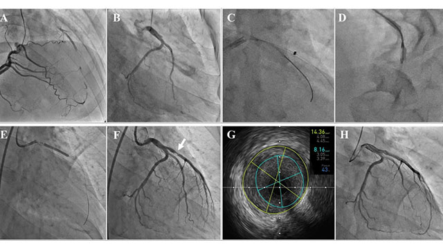Successful Stent-less Percutaneous Coronary Intervention of Chronic Total Occlusion by Ablation Devices in a Young Adult