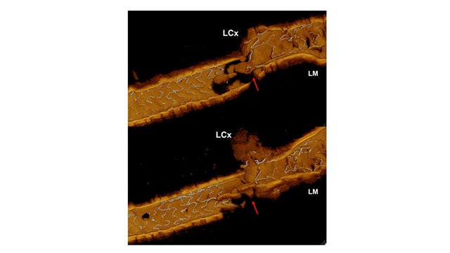 3D OCT to identify cause of NSTEMI