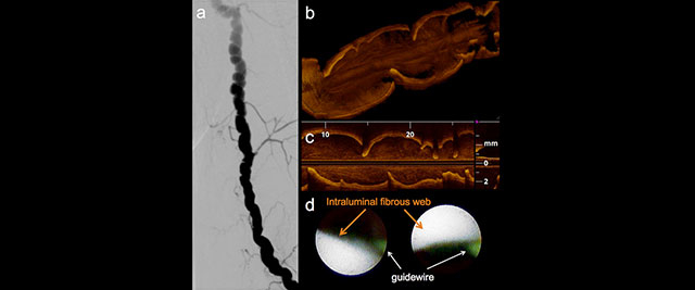 Brachial artery fibromuscular dysplasia
