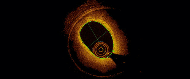 Image in interventional cardiology: IVUS