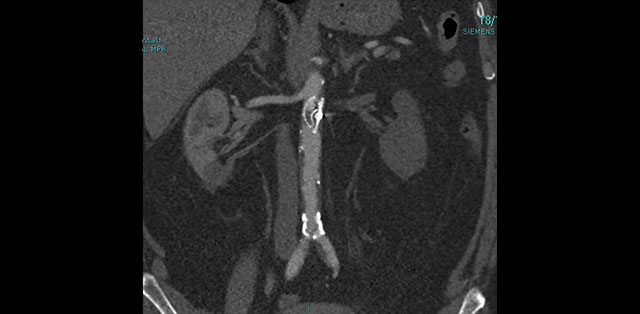 Image in interventional cardiology: end up below diaphragm
