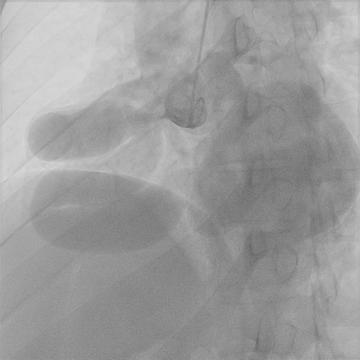 Large right coronary artery like a colon drains into left ventricle by big fistula with volume overload