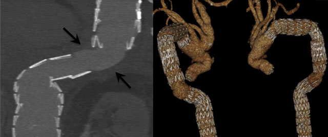 Late stent migration in thoracic endovascular aortic repair: a potentially lethal complication