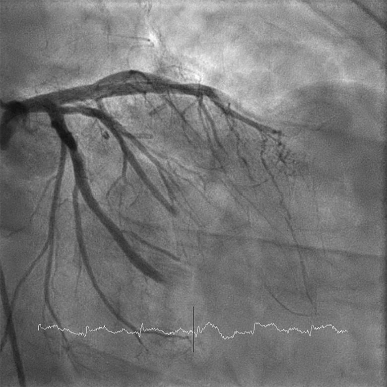A peri-operative arrest