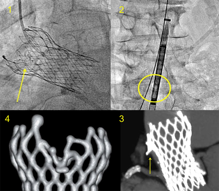 Aortic valve prosthesis distortion secondary to improper loading in a patient undergoing TAVR