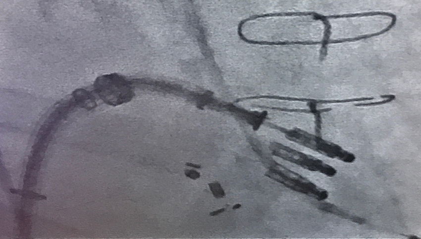 More than one transcatheter device is implanted