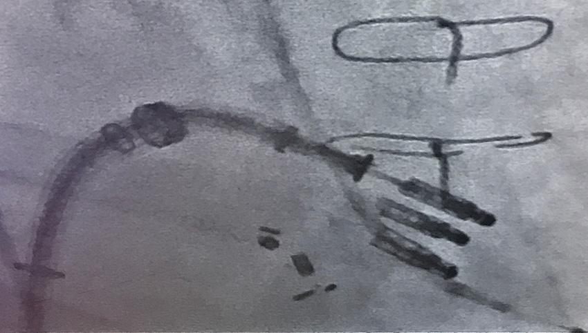 More than one transcatheter device is implanted
