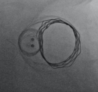 Multiple devices inside a large stent