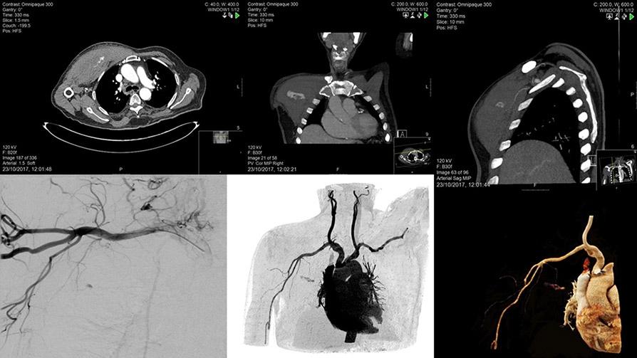 Transradial angiography - Are we free of complications?