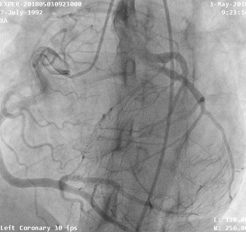A rare case of cardiomyopathy