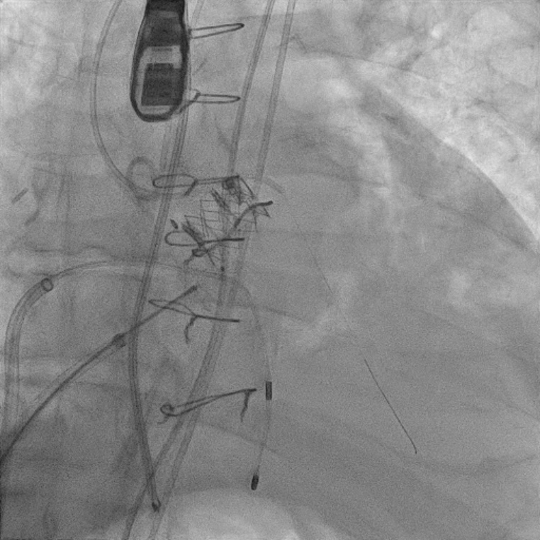 It is more than a TAVR