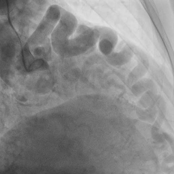 It began with a pneumonia: an incidental finding