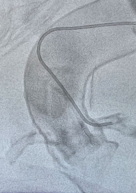 What challenge associated with coronary access following ViV-TAVR is overcome by this novel “Vertical Judkins” technique?