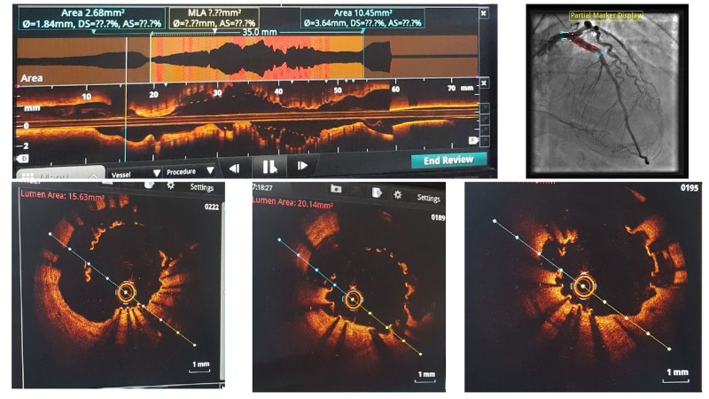 An unusal case of recurrent ACS and STEMI