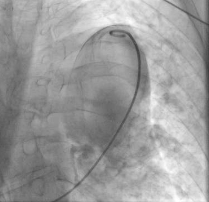 Is it just a simple right heart catheterisation?