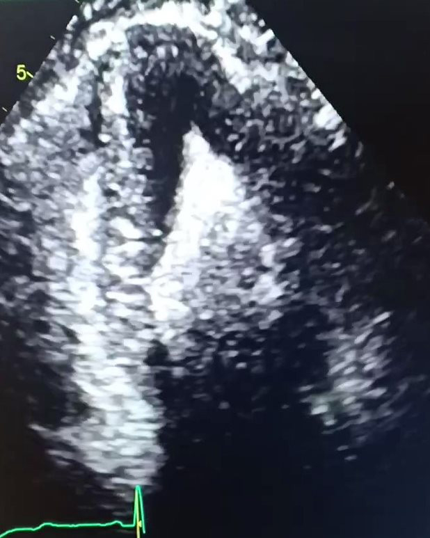 Inconspicuous yet sinister cause of angina in a young male !
