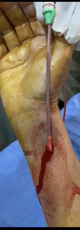 Forceful removal of right radial sheath