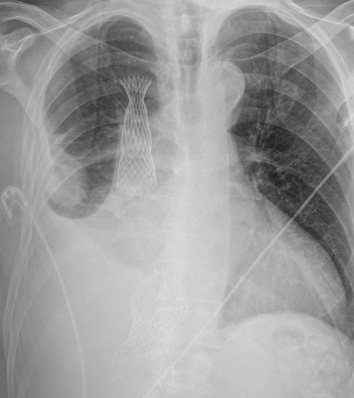 A different device in the inferior vena cava: what happened?