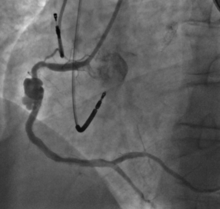 A late uncommon finding after PCI
