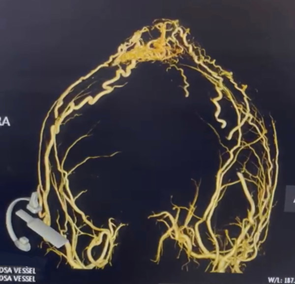 A rare vascular cap