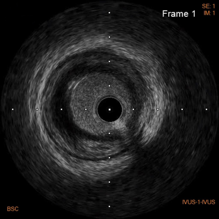 Ambiguous angiography finding after coronary intervention