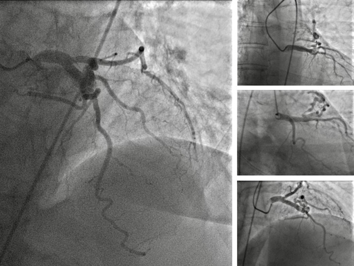 An unusual case of acute coronary syndrome