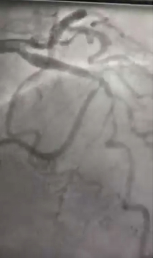 Coronary image: what do you see?