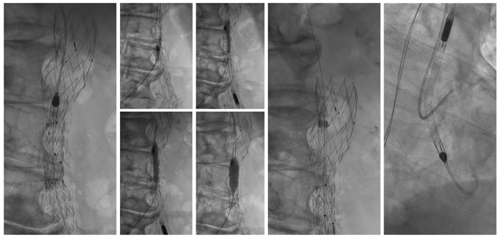 Impella CP-protected PCI status post abdominal aortic aneurysm repair