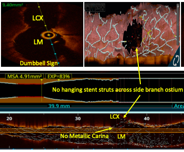 OCT in LM bifurcation angioplasty with double kissing crush technique