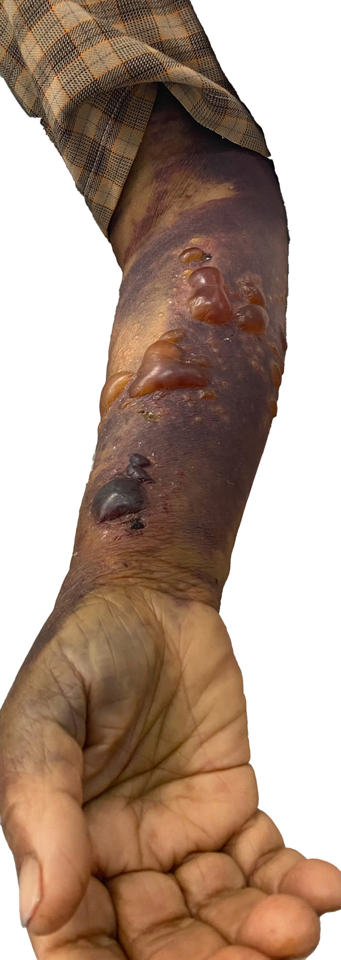 Post radial artery coronary angiogram in an 82-year-old woman