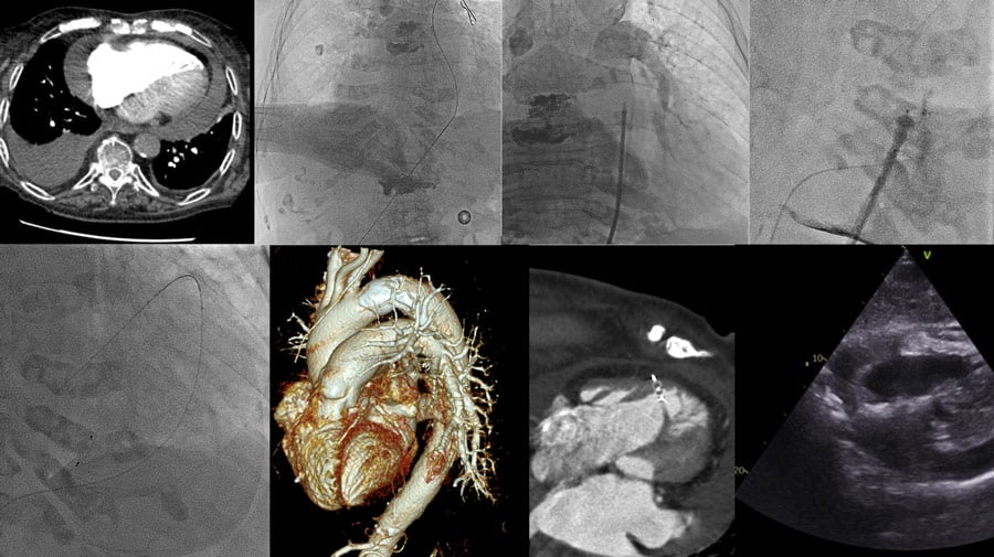 Strange image in the right ventricle wall