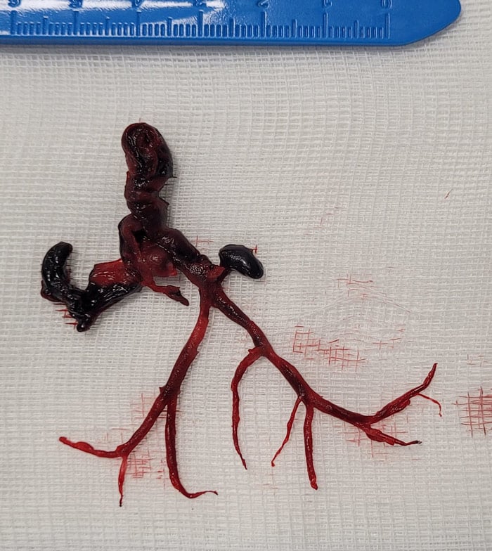 Thrombotic material: Where does it come from?